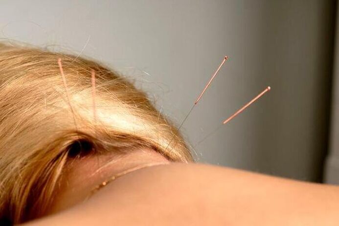 osteokondroz uchun akupunktur