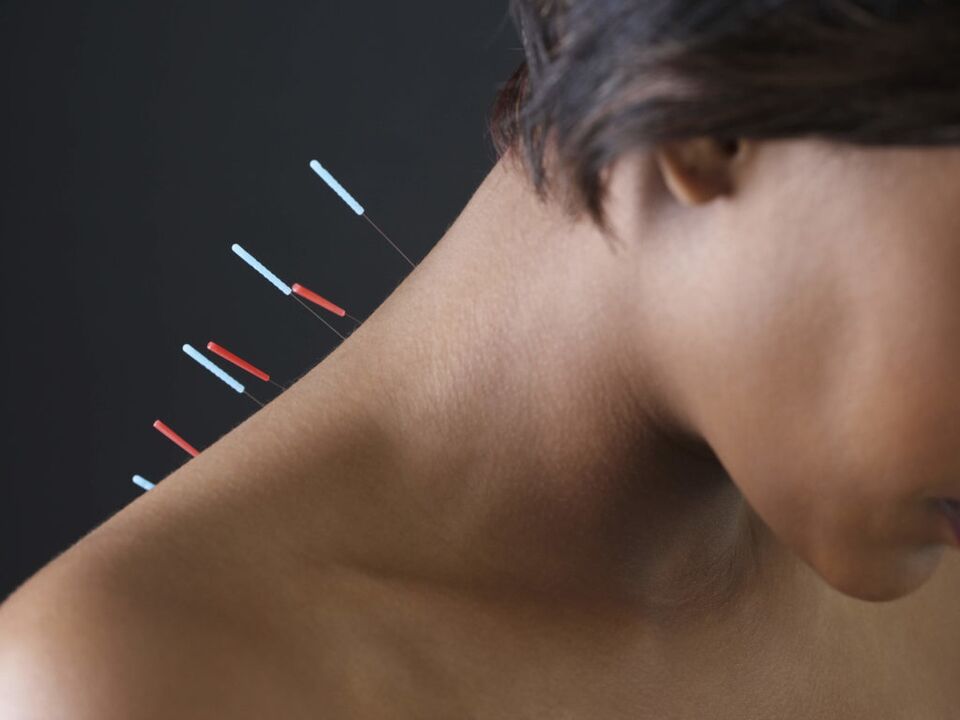 Servikal osteokondroz uchun akupunktur yallig'lanish jarayonlarini yo'q qiladi